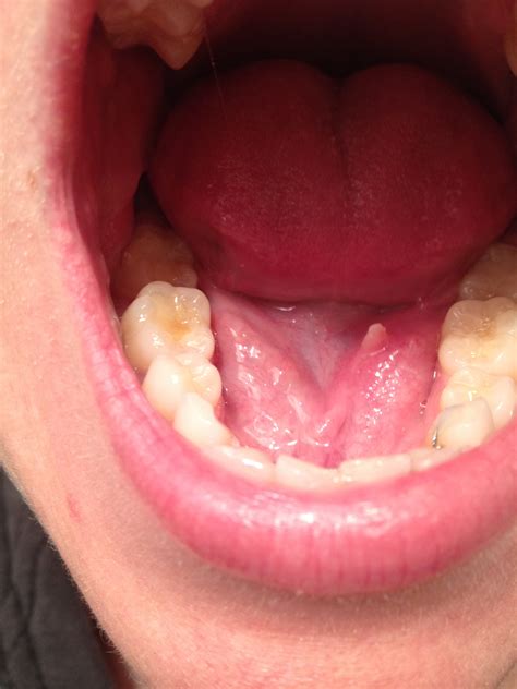 sininentuki.info:floor of mouth under tongue flap