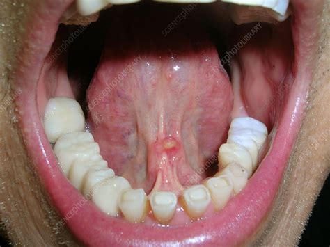 floor of mouth under tongue flap