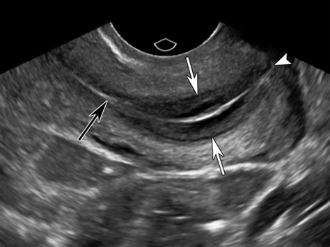 Endovaginal US scan in the short axis of the cervix showing the mucosal