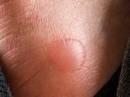 Fluid Filled Bubbles On Feet