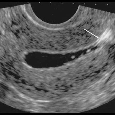fluid filled endometrial cavity
