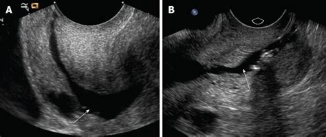 fluid filled endometrium on ultrasound