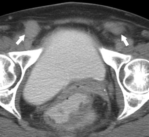 fluid in inguinal canal radiology