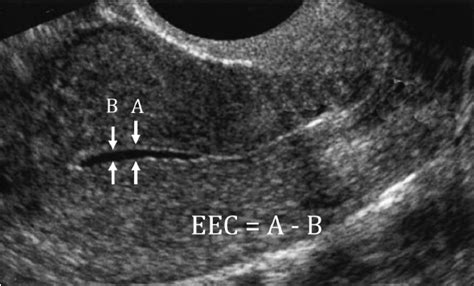 fluid in uterine cavity on ultrasound