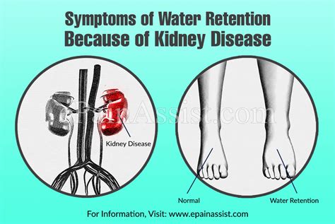 Fluid Retention Causes Kidney