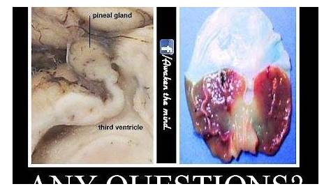 Fluoride Calcification Pineal Gland Literally Turns The To Stone