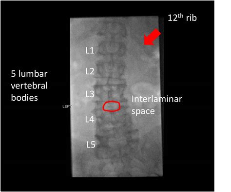 fluoroscopy guided lp
