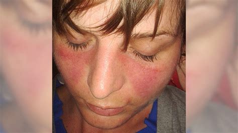 Flushed Cheeks Low Blood