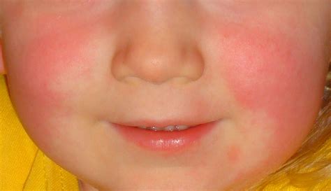 Flushed Cheeks Scarlet Fever