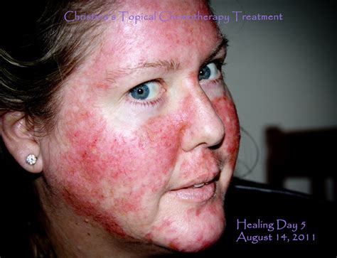 Flushed Face Chemotherapy