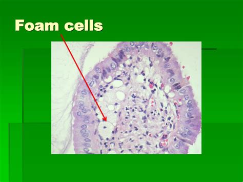 Foam Cell Transition