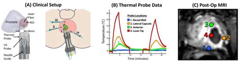 focal laser cpt code
