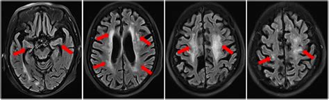 Foci Brain Definition