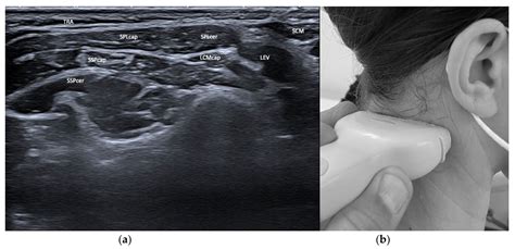 focused ultrasound for cervical dystonia