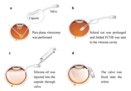 foldable capsular vitreous body