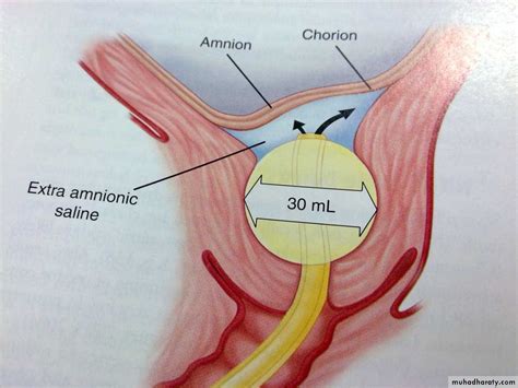 Foley Bulb Induction Experiences