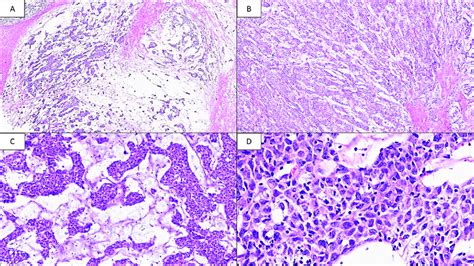 follicular dendritic sarcoma