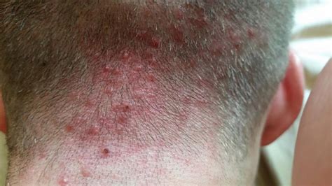 Folliculitis