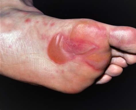Foot Blisters Recurring