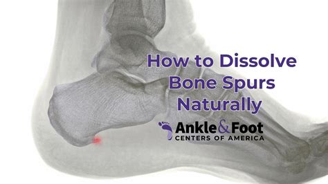 Understanding and Treating Foot Bone Spur Symptoms Effectively