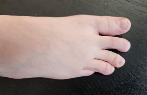 Foot Bone Under Pinky Toe