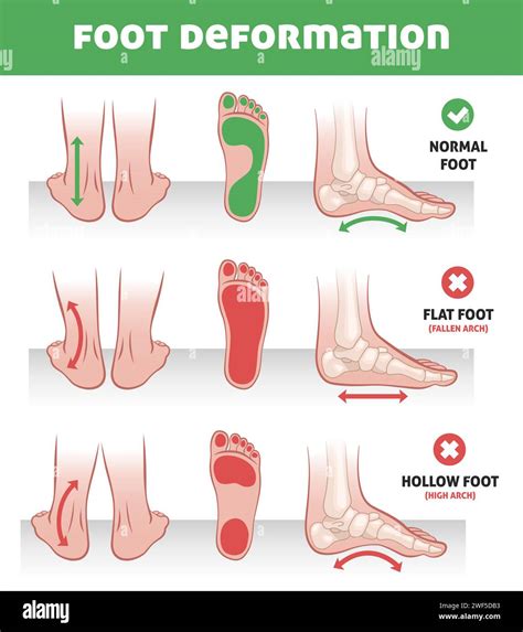 Foot Bones Deformation