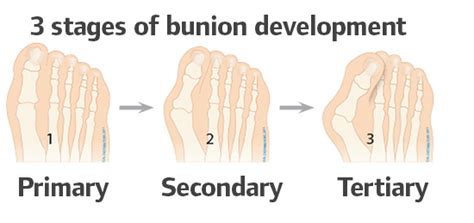 Foot Bunion Development