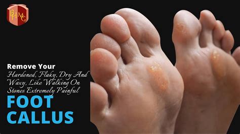 Foot Callus Surgery