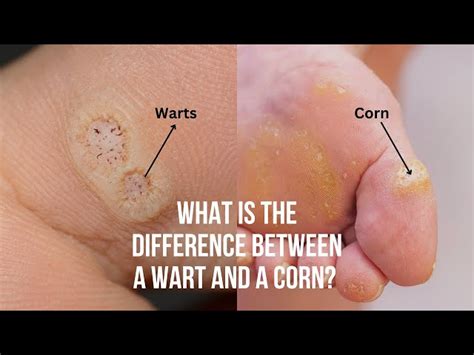 Foot Corn And Wart Difference