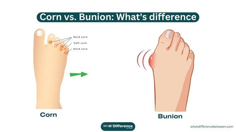 Foot Corn Vs Bunion