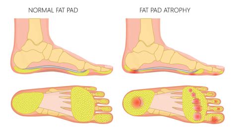 Foot Fat Pad Atrophy Treatment