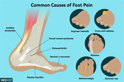 Foot Hurts Underneath When Walking