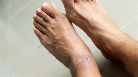 foot ulcers pictures