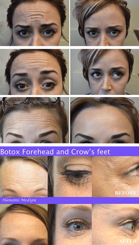 forehead botox gone wrong