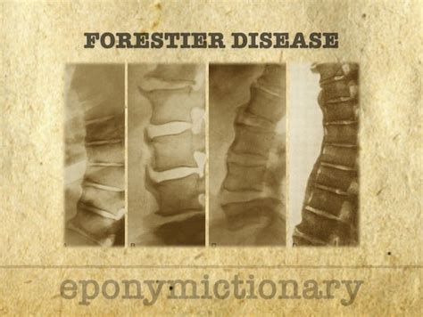 forestier's disease hereditary