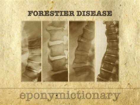 forestier's disease wiki