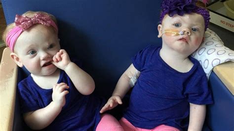 formerly conjoined twins update