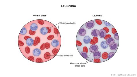 forms of leukaemia