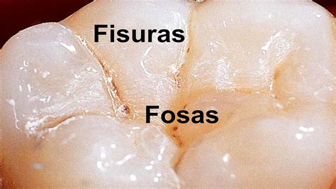 fosas y fisuras dentales