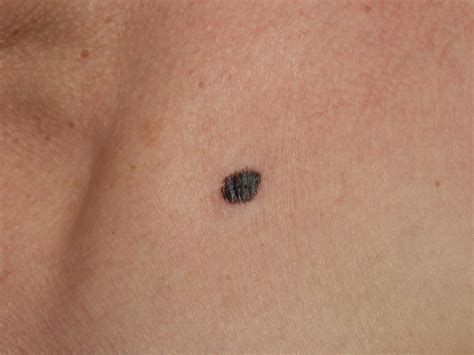 foto di melanoma della pelle