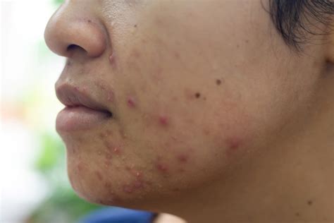 5 Rahasia Menghilangkan Jerawat Mendem yang Ampuh