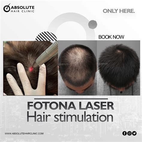 Fotona SP Dynamis Laser for hair loss Absolute hair clinic