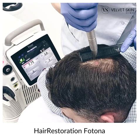 Hair Restoration Fotona laserowa stymulacja wzrostu włosów Velvet