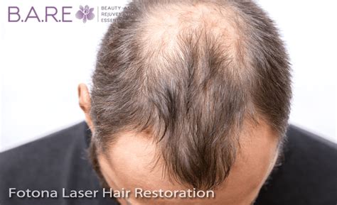Fotona SP Dynamis Laser for hair loss Absolute hair clinic