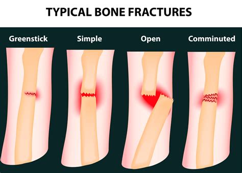 Fracture In Bone