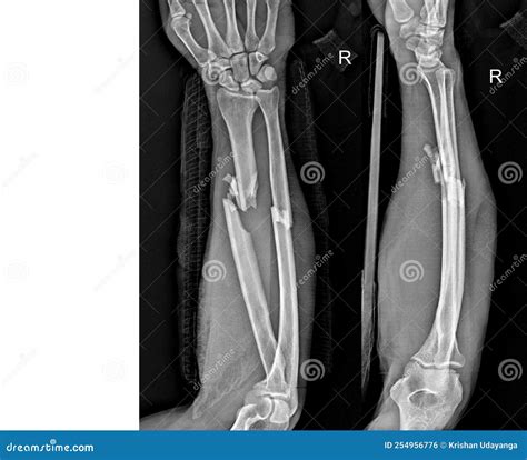 Fracture On X Ray