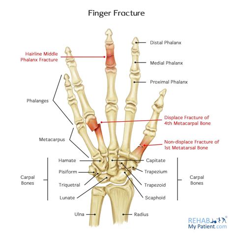 Fractured Finger Tip: Causes, Symptoms, and Effective Treatment Options