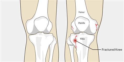 Understanding and Managing a Fractured Knee Cap: Causes, Symptoms, and Effective Treatments
