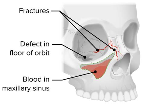 What You Need to Know About a Fractured Orbital Bone: Causes, Symptoms, and Treatment Options