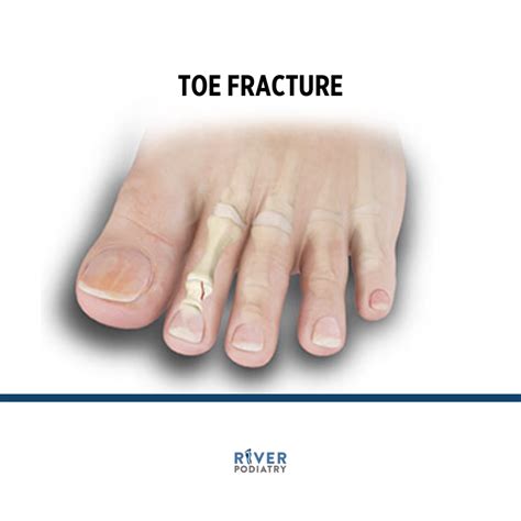 How Long Does Fractured Toe Healing Time Take? A Comprehensive Guide to Recovery